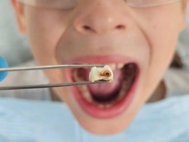 Best Knocked-Out Tooth (Avulsed Tooth) Treatment in Sweetwater, TN